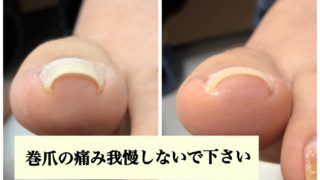 巻爪の痛みに悩んでいたお客様＆オススメネイルデザイン