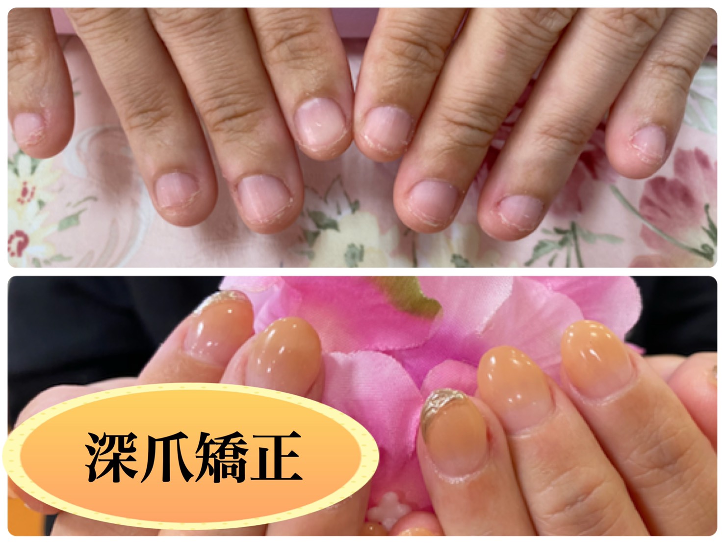 深爪矯正メニュー