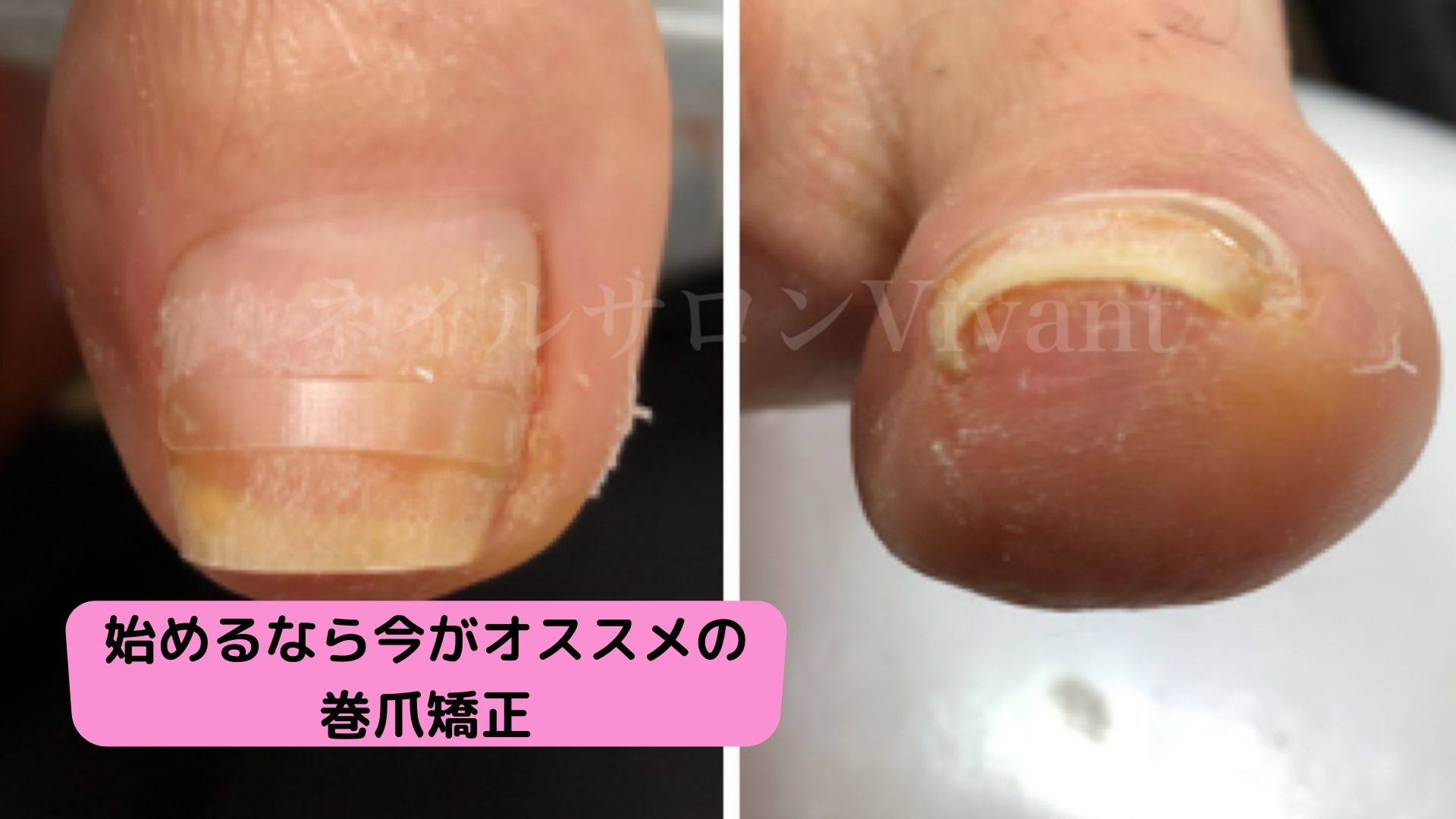 巻爪矯正を始めるのに冬がオススメな理由！！＆フットケアご紹介｜香川 